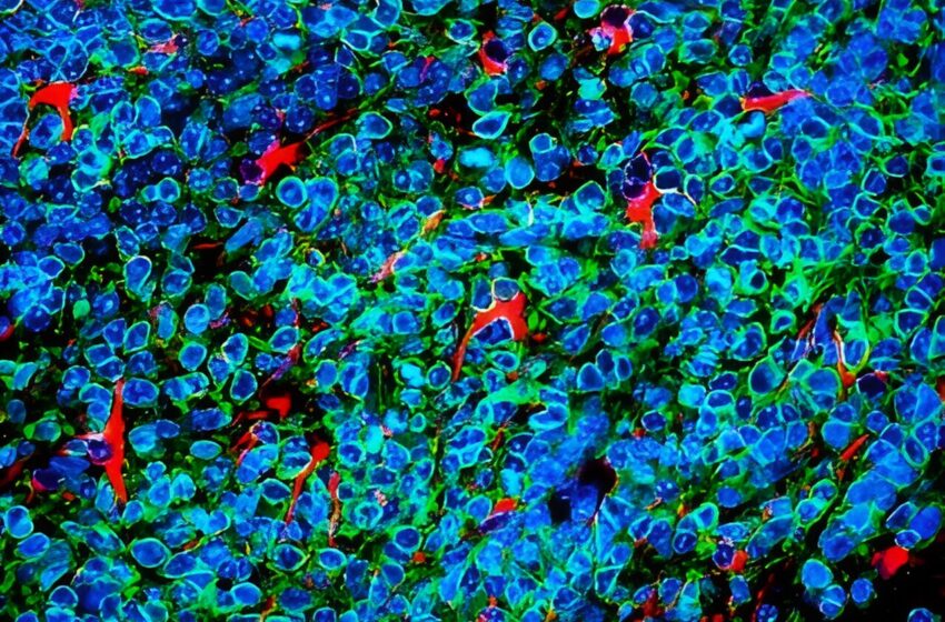  Les cellules cancéreuses du poumon se développent secrètement dans le cerveau sous couvert de protection, selon une étude