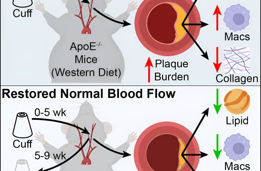  Un flux sanguin normal peut stabiliser la plaque et réduire le risque d’événements cardiaques