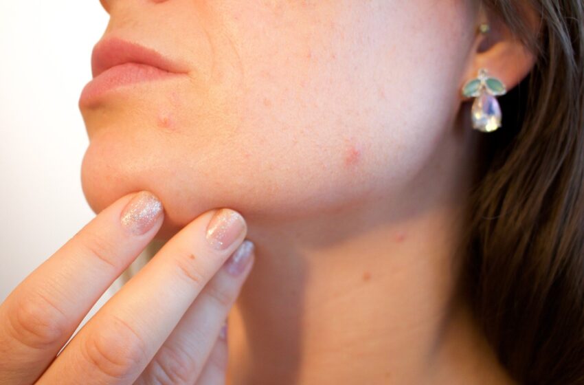  Une méta-analyse sur le traitement nutraceutique de l’acné suggère que de meilleures études sur le traitement nutraceutique de l’acné sont nécessaires