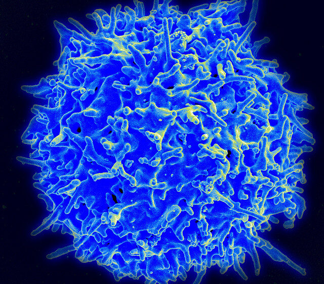  Des scientifiques conçoivent des cellules immunitaires puissantes pour l’immunothérapie anticancéreuse « prêt à l’emploi »
