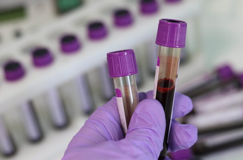  Des scientifiques inventent un test rapide unique pour le VIH et la tuberculose