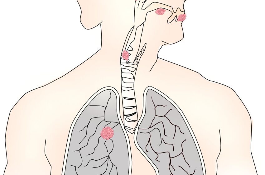  La génétique des tissus sains voisins peut aider à détecter le retour du cancer du poumon