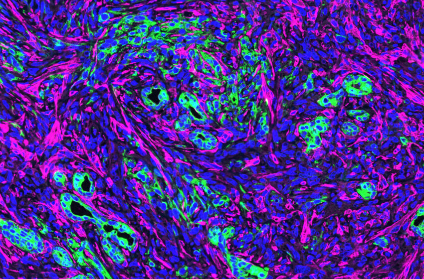  Comment les médicaments peuvent cibler l’épais « tissu cicatriciel » du cancer du pancréas