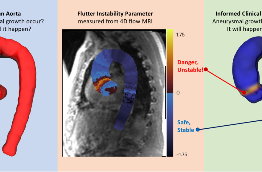  Un « flottement » instable prédit un anévrisme aortique avec une précision de 98 %
