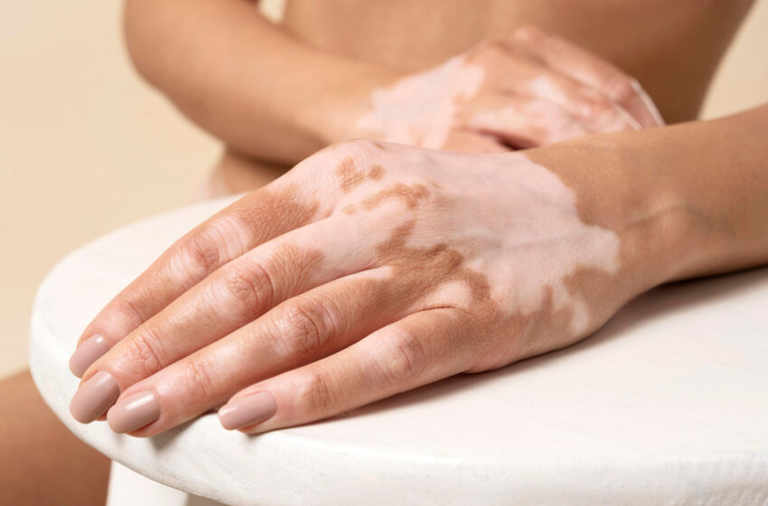  Le premier traitement contre le vitiligo sera disponible en France