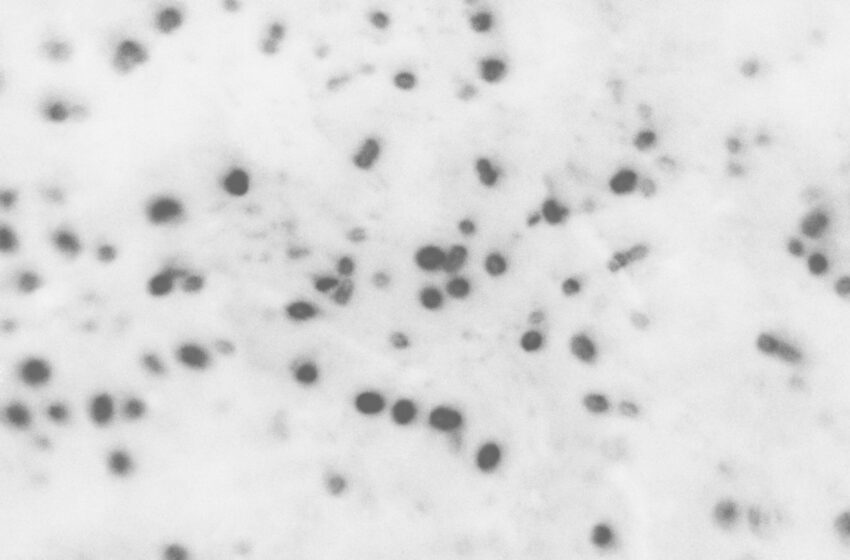  La plupart des enfants reçoivent des antibiotiques contre les yeux roses, selon une étude.  Les experts disent qu’ils ne sont généralement pas nécessaires