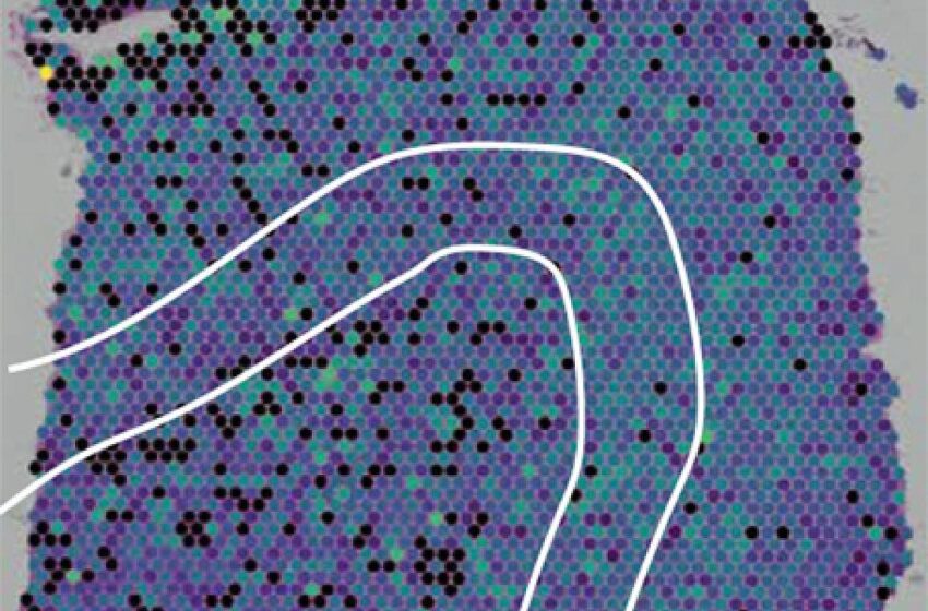  Les scientifiques identifient des gènes liés à la perte de cellules cérébrales dans la sclérose latérale amyotrophique