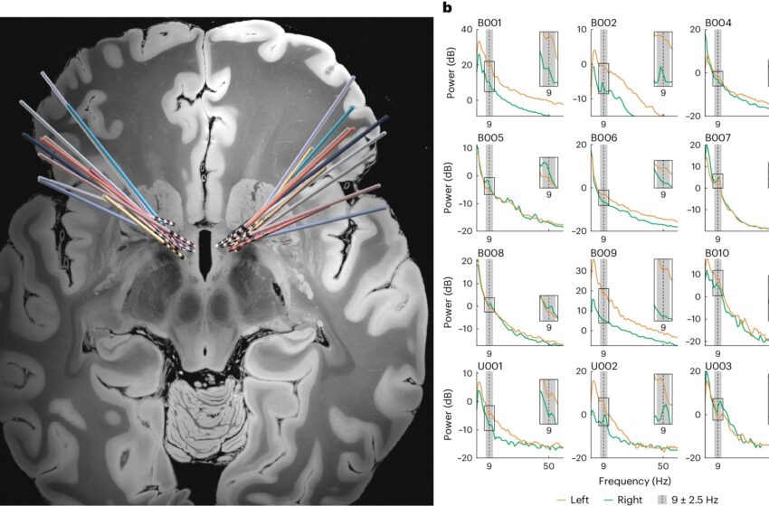  Des chercheurs découvrent un nouveau biomarqueur neuronal pour le trouble obsessionnel-compulsif