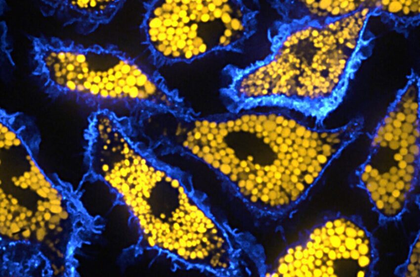  Des chercheurs discutent de l’inflammation cellulaire découverte dans une maladie neurodégénérative rare