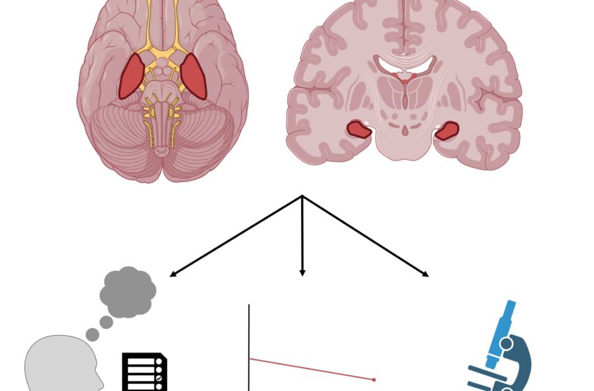  Des scientifiques définissent un nouveau type de perte de mémoire chez les personnes âgées