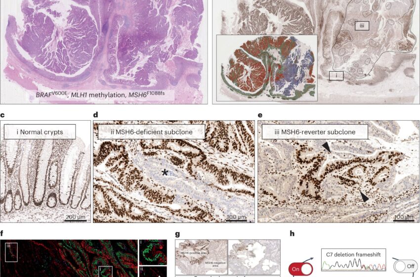  Le cancer de l’intestin active et désactive des commutateurs génétiques pour déjouer le système immunitaire, selon une nouvelle étude