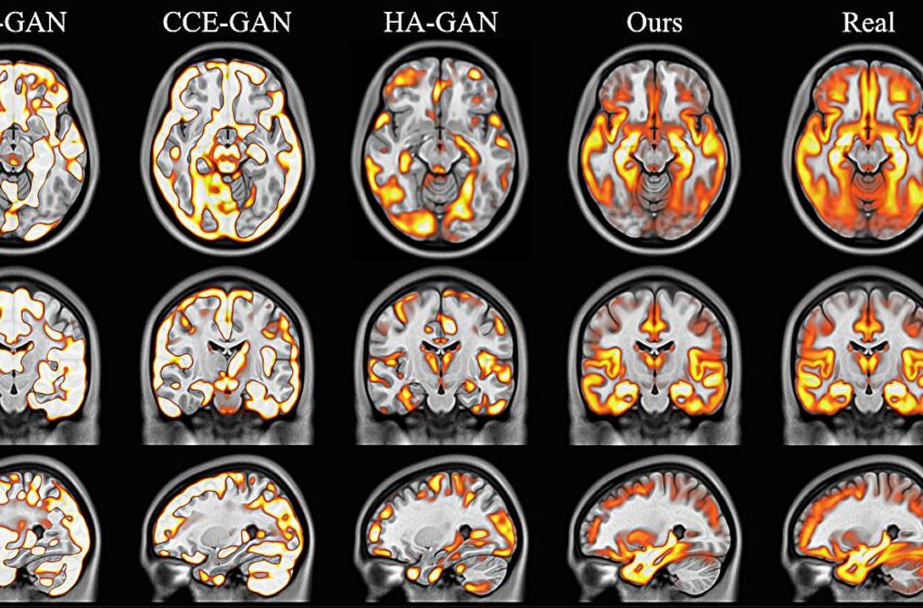  Les images cérébrales de l’IA créent des données synthétiques réalistes à utiliser dans la recherche médicale