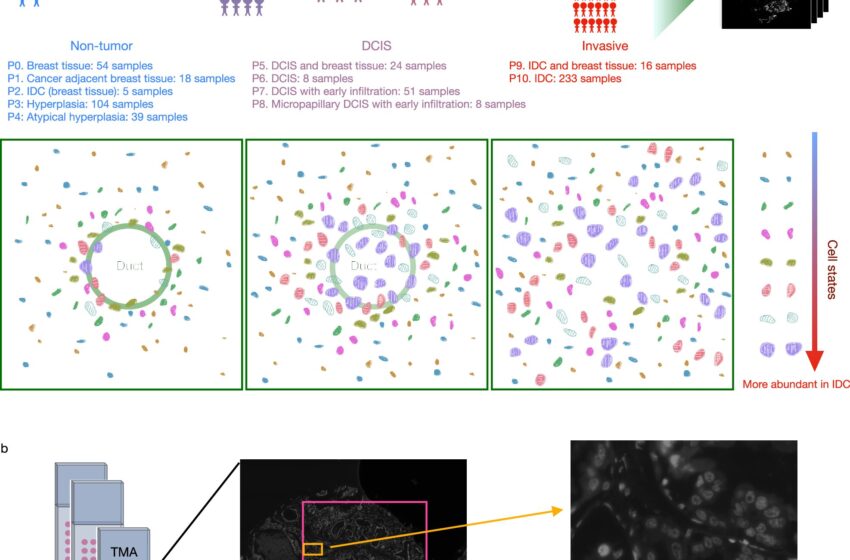  Un modèle d’IA identifie certains stades de tumeurs mammaires susceptibles d’évoluer vers un cancer invasif