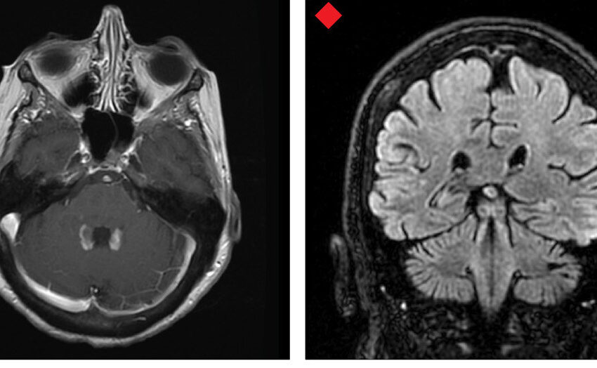  Une forme de carence en vitamine B12 dans le liquide céphalo-rachidien affecte négativement le système nerveux central