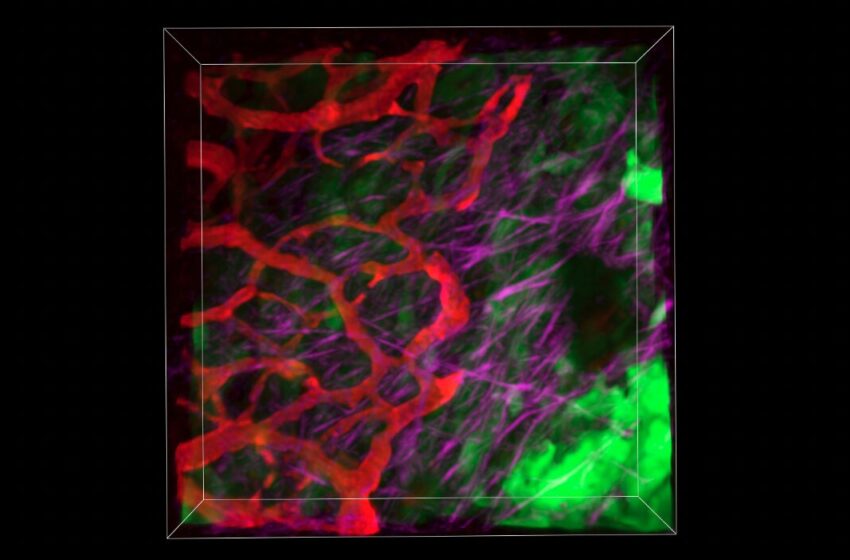  Une nouvelle cible prometteuse découverte dans le cancer du pancréas pourrait stimuler la chimiothérapie et réduire la propagation