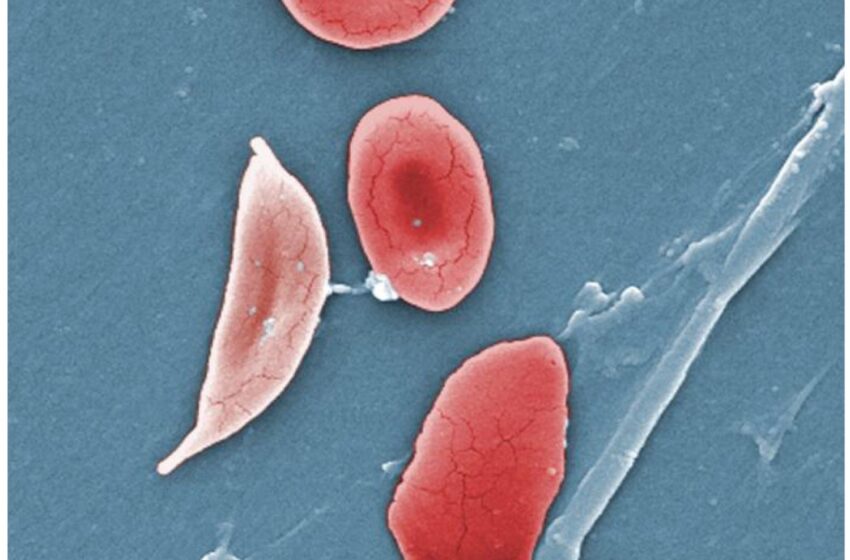  Une nouvelle petite molécule pourrait traiter la drépanocytose chez les adultes qui ne répondent pas à l’hydroxyurée seule