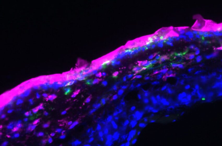  Une pommade contenant des molécules d’ADN peut combattre la dermatite de contact allergique