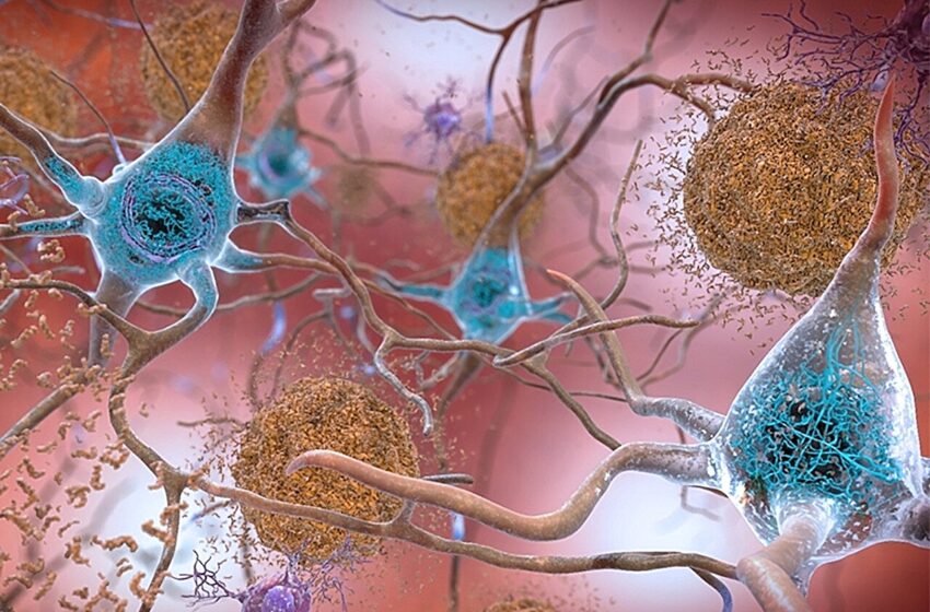  De nouvelles découvertes suggèrent des mécanismes alternatifs à l’origine de la maladie d’Alzheimer