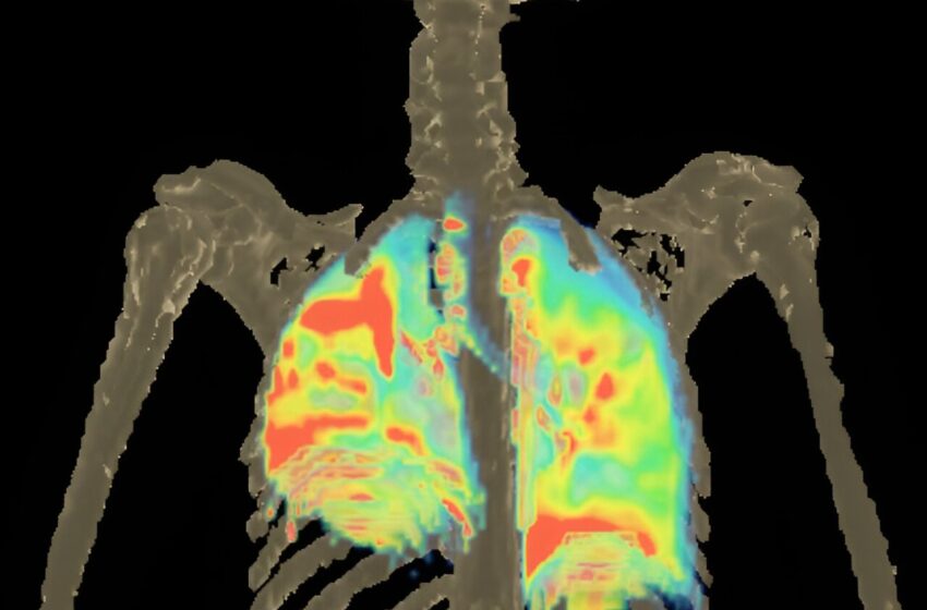  Des chercheurs signalent de nouveaux schémas thérapeutiques potentiels pour la méningite à tuberculose multirésistante