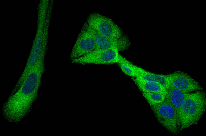  Des scientifiques ont trouvé un moyen d’affamer les cellules cancéreuses du sein