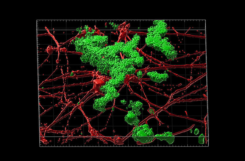  Grâce à une nouvelle technique, les neurones dérivés de patients modélisent avec précision la maladie d’Alzheimer à apparition tardive