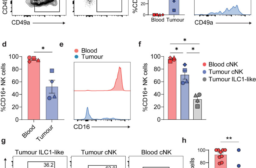  La découverte d’un cancer de la vessie ouvre la voie à une nouvelle voie thérapeutique potentielle