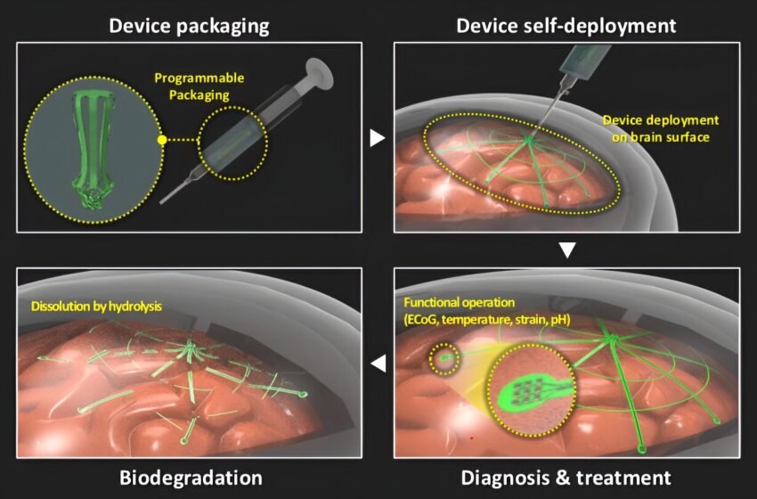  L’électrode biodégradable auto-déployable offre une surveillance minimalement invasive du signal cérébral