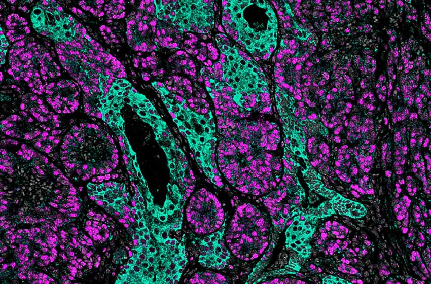  Une étude enzymatique dévoile des stratégies clés contre le cancer de la prostate résistant aux médicaments