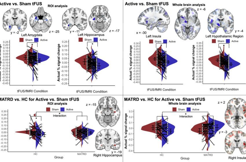  Une nouvelle technique de stimulation cérébrale non invasive montre une réduction significative de la dépression, de l’anxiété et des symptômes du SSPT
