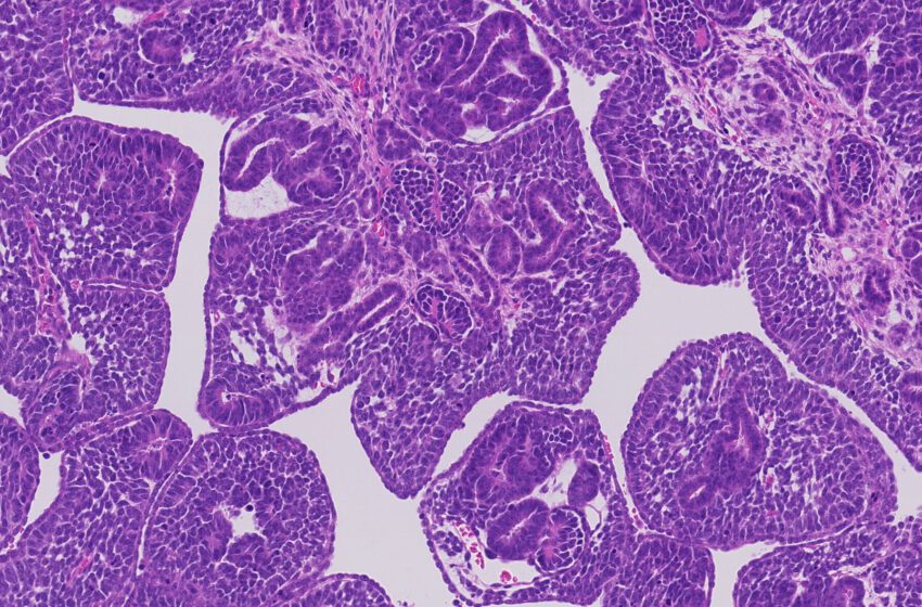  Le cancer du rein de l’enfant a des millions de changements génétiques, ouvrant la porte à des traitements possibles
