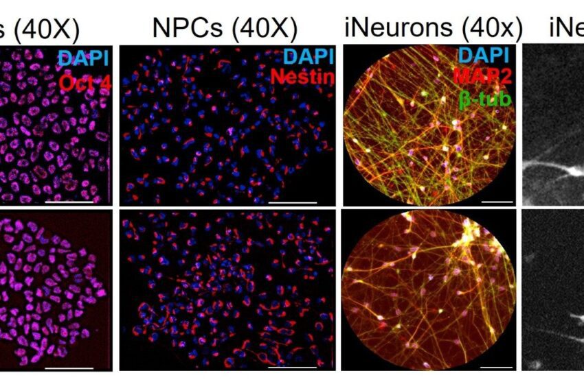  Une protéine atténue la maladie de Huntington, et on l’exacerbe